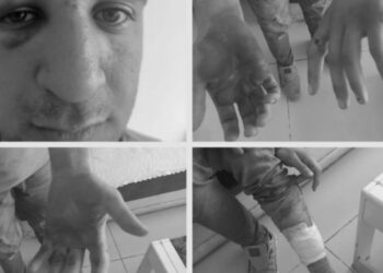 Kurdish teenager tortured by Turkish military with pliers