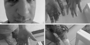 Kurdish teenager tortured by Turkish military with pliers