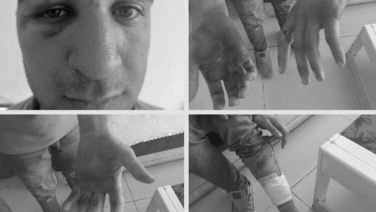 Kurdish teenager tortured by Turkish military with pliers